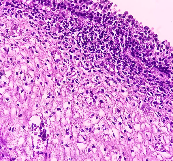 Types of bladder cancer