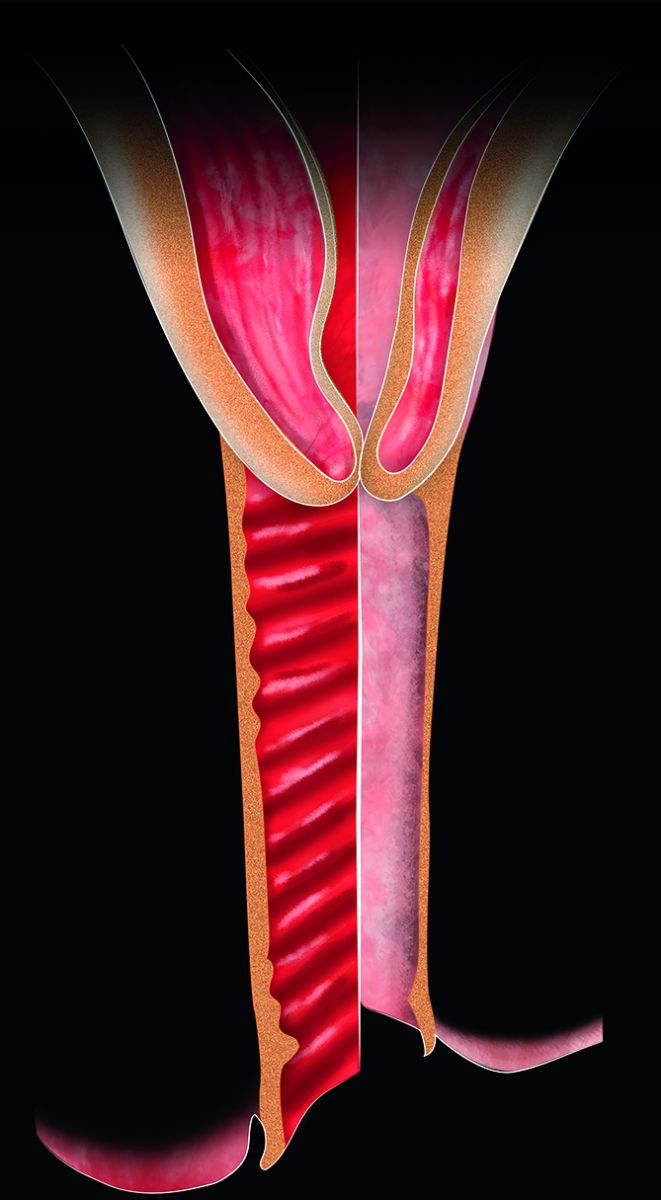 Pessary Ring Treats Pelvic Organ Prolapse - Patient Care - mobile