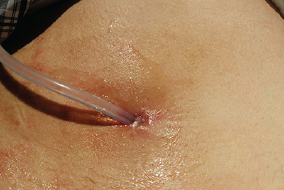 Suprapubic trial without catheter in community settings