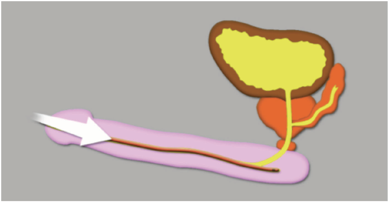 Figure 1. Development of a false passage at the bulbar urethra.