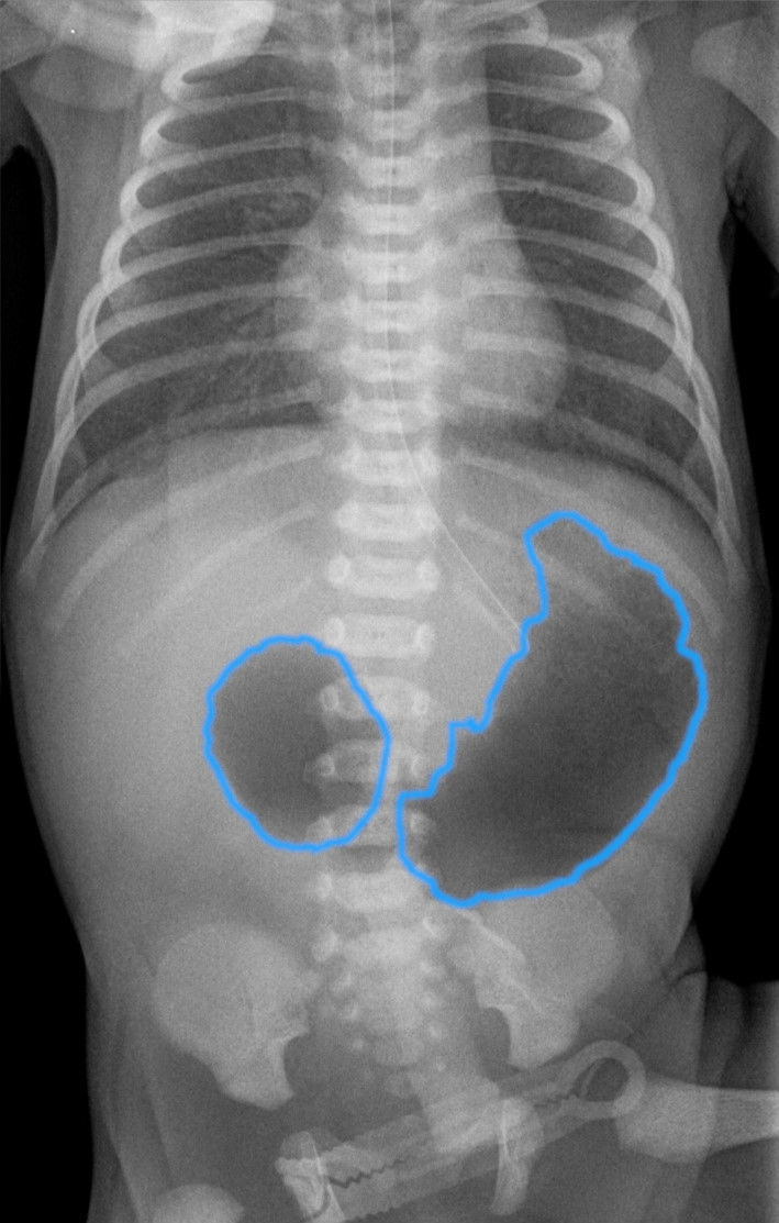 Double-bubble sign in a patient with duodenal atresia.
