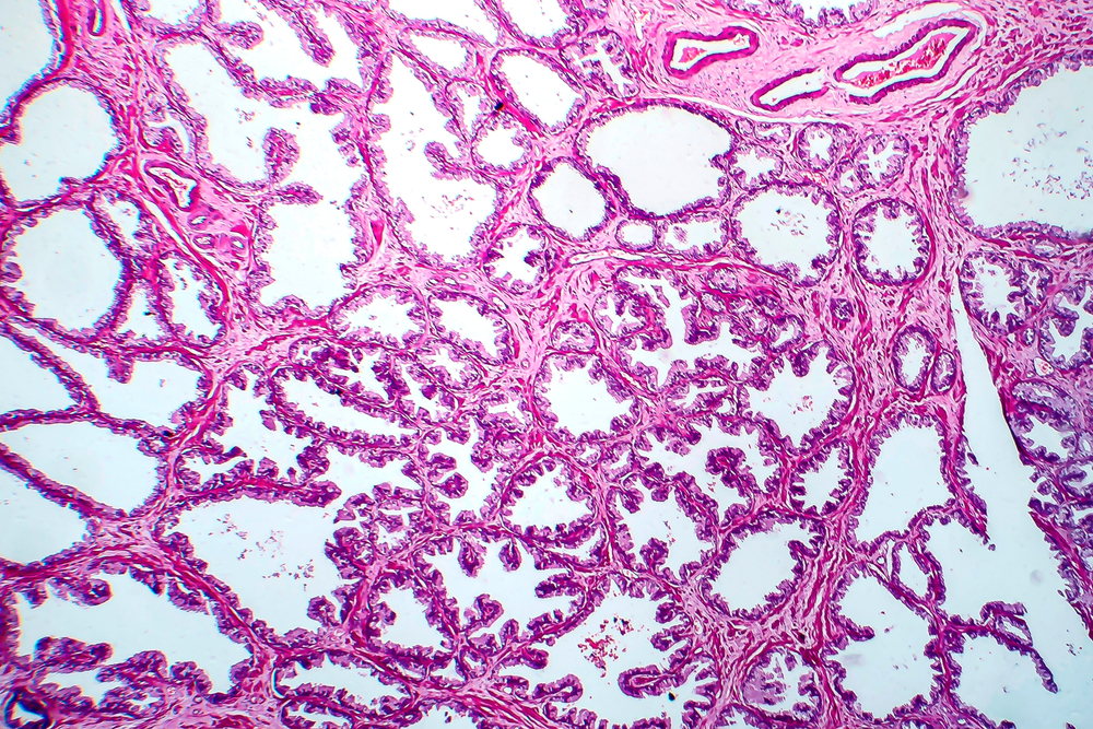 Treating hormone-sensitive metastatic prostate cancer: new NICE guidance